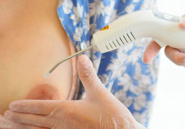 Laserterapia: Uma solução inovadora e eficaz para fissuras na mama durante a amamentação. Descubra seus benefícios e como encontrar um profissional qualificado.